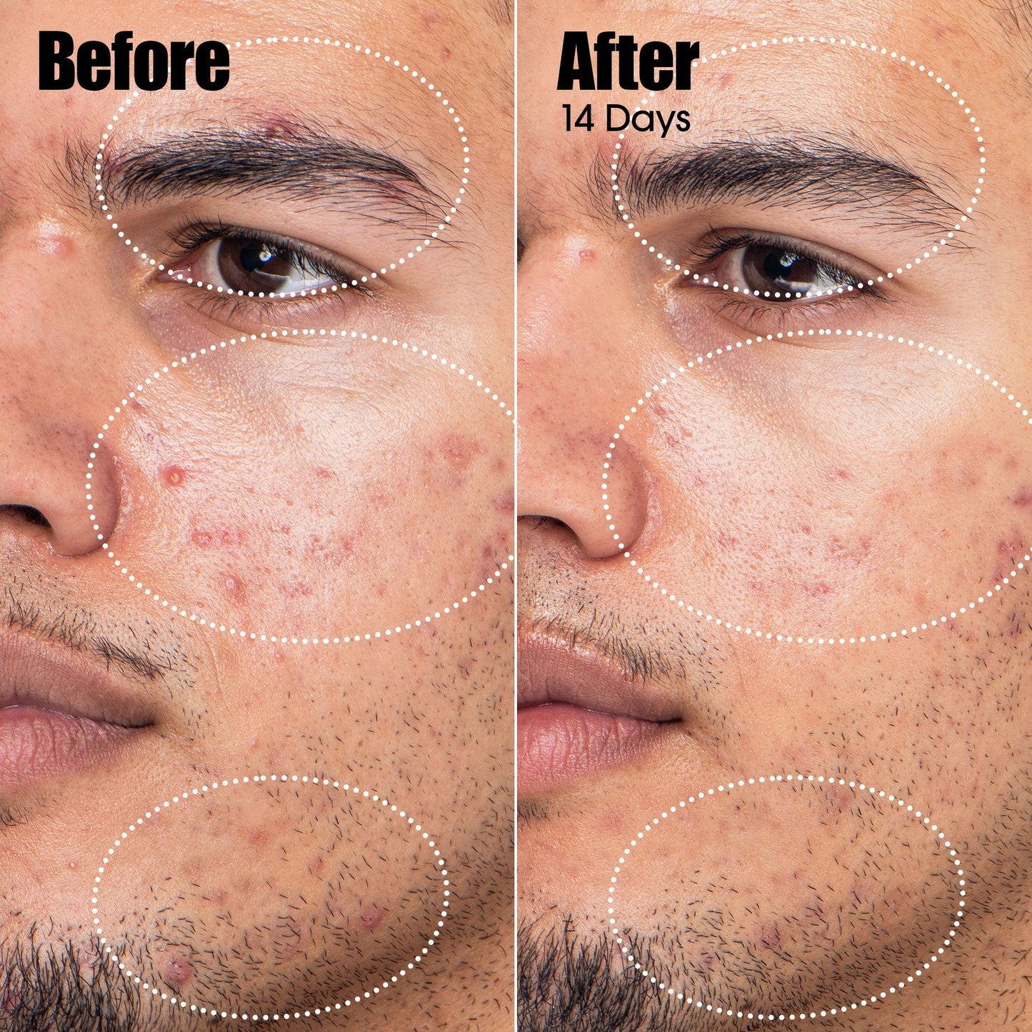 Peacekeeper Acne Treatment Serum