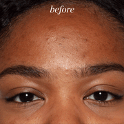 Good Genes before and after, forehead close up. Visually reduced the look of dark spots, dark spots, and discoloration caused by exposure to the sun 7 days of use